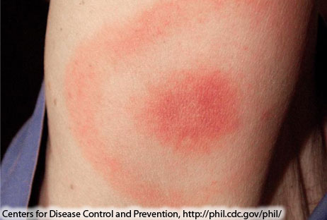 Photo-Lyme Disease Bullseye Rash